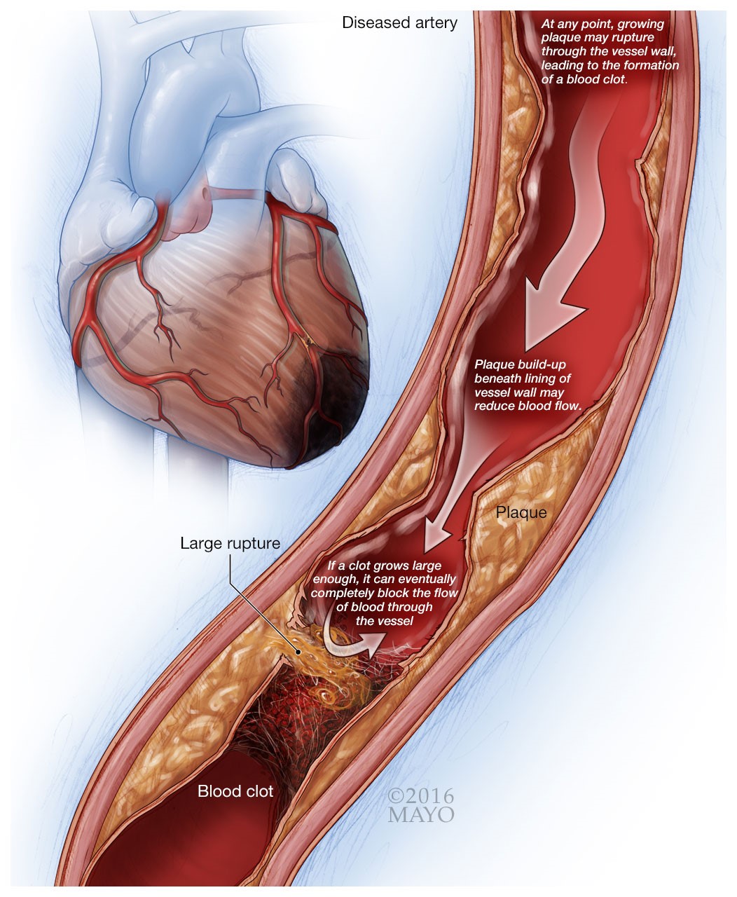 causes of High BP